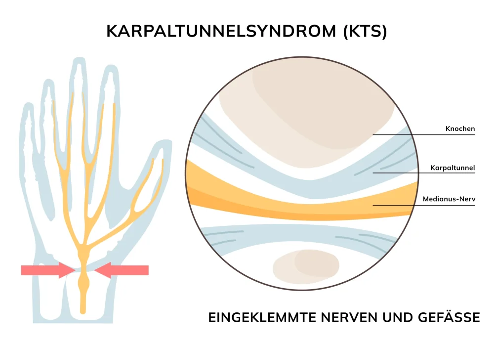 Anatomie des Karpaltunnels: eingeklemmte Nerven und Gef&auml;&szlig;e