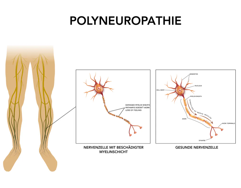 Wissenschaftliche Forschung Polyneuropathie