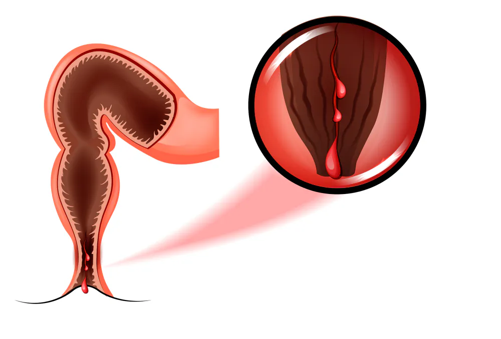 Anatomische Darstellung des Analbereichs mit Analfissuren